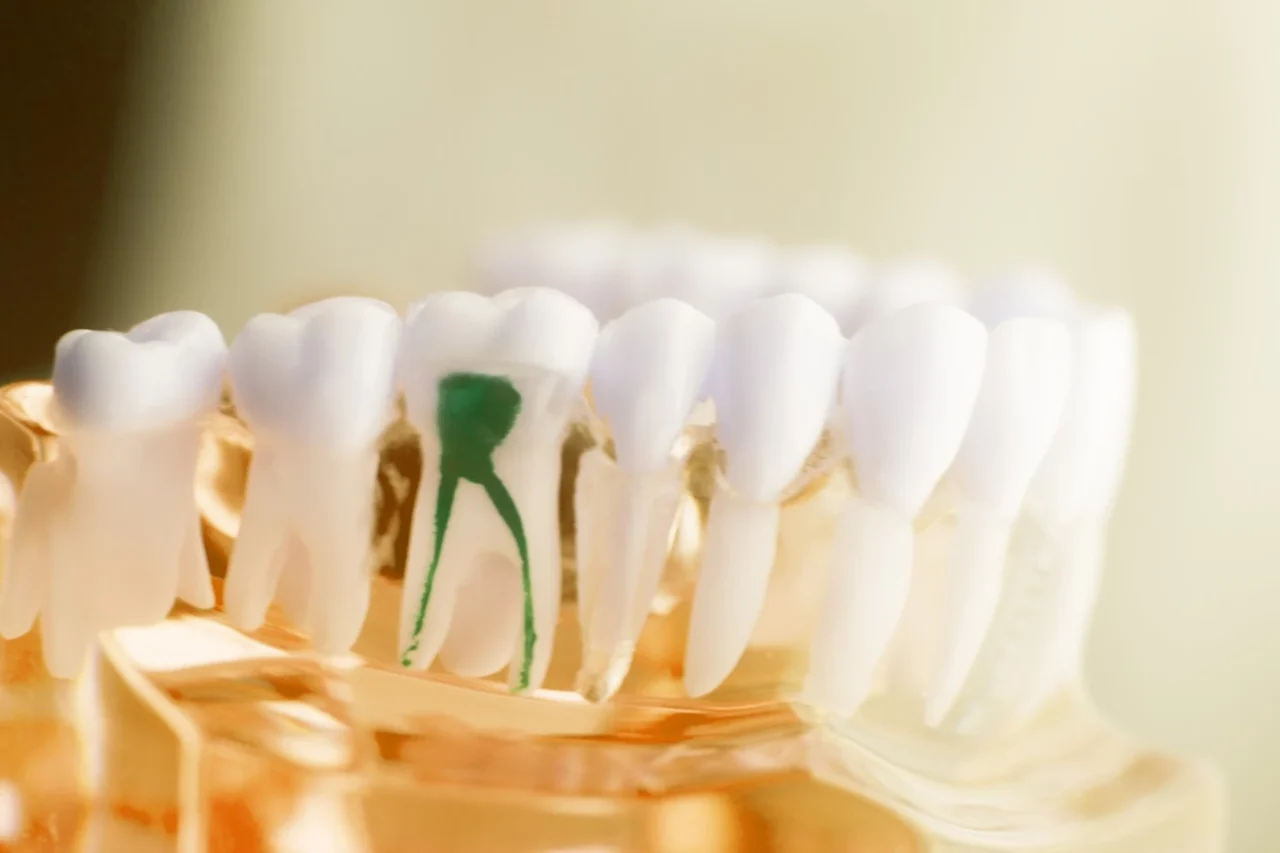 Kök Ucu Açık Daimi Dişlerde Tedaviler (Apeksifikasyon, Apeksogenezis)