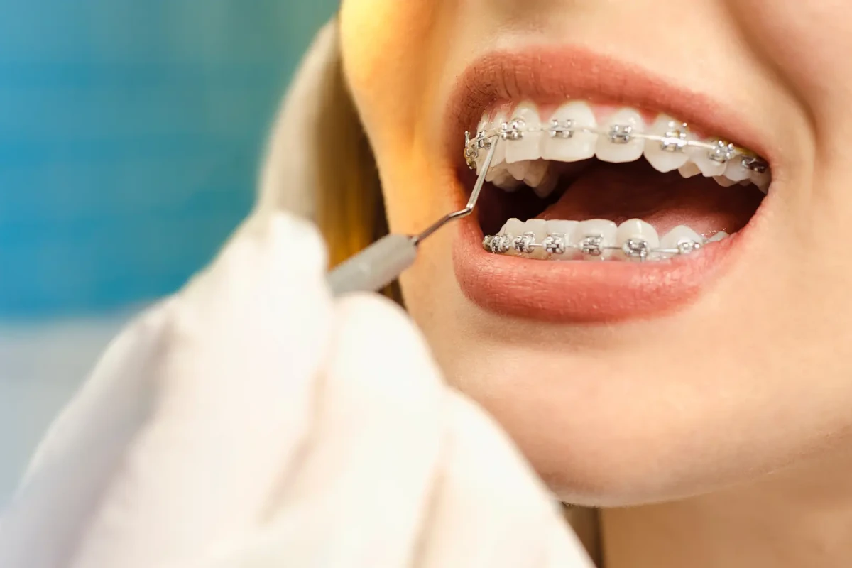 Ortodonti (Diş Teli) Tedavileri